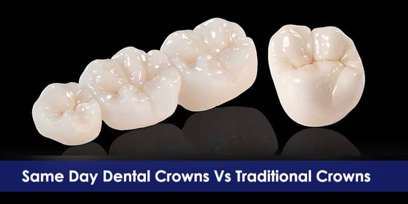 Same Day Dental Crowns versus Conventional Crowns