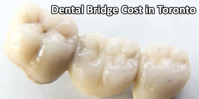 Dental Bridge Cost