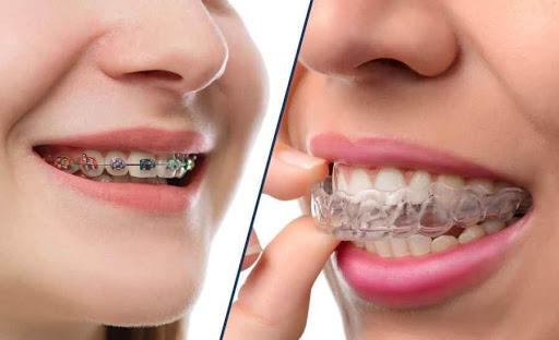 Traditional Braces in Thornhill