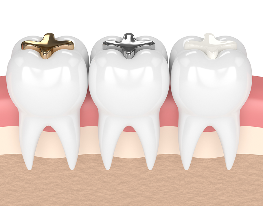 Dental Sealant Cross Section